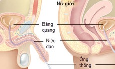 Ðiều cần lưu ý cho người đặt ống thông bàng quang