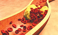 Điều trị tăng cholesterol sau 7 năm vẫn nhồi máu cơ tim
