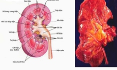 Viêm cầu thận cấp:  Phát hiện sớm, điều trị nhanh