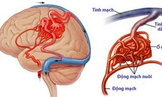 Dị dạng mạch não biểu hiện thế nào?