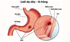 Kết hợp đông, tây y trong điều trị viêm loét dạ dày - tá tràng