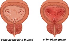 Viêm bàng quang tái phát có nguy cơ gì?