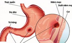 Có nên đổi thuốc băng se niêm mạc dạ dày