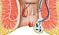 Trĩ nội, khi nào cần phẫu thuật?
