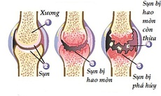 Bệnh thoái hóa khớp đang có xu hướng trẻ hóa