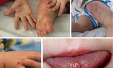 Ca mắc tay chân miệng tăng cao ở TP.HCM và Đăk Lăk: Bệnh dễ lây lan, không được chủ quan