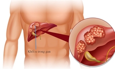 Cách phát hiện sớm ung thư gan