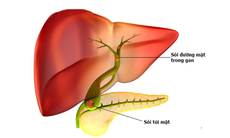 Cảnh giác sỏi đường mật trong gan