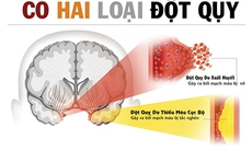 Cấp cứu đột quỵ: Sự sống tính trong từng phút giây