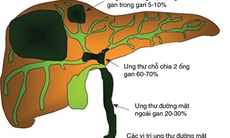 Vàng da có thể là một dấu hiệu của ung thư đường mật