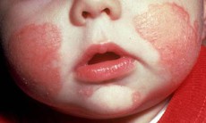 3 điều khiến bệnh eczema tệ hơn