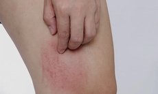 Khi dùng cetirizine trị dị ứng cần lưu ý gì?