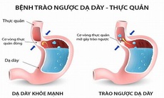 Vì sao trào ngược dạ dày thực quản lại gây ho?