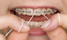 Sau niềng răng phải biết giữ gìn và vệ sinh răng miệng