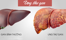 Điểm mặt đồng minh của ung thư gan 