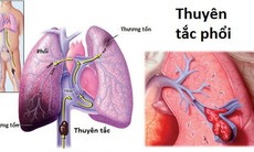 Đối tượng dễ mắc thuyên tắc phổi