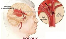 Lấy huyết khối cơ học - Cứu cánh cho bệnh nhân đột quỵ