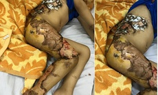 Hà Nội: Bé trai 4 tuổi hoại tử da vì đắp lá chữa bỏng