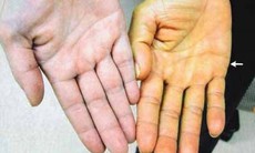 WHO khuyến nghị tiêm vắc xin phòng sốt vàng trước dịch bệnh gia tăng