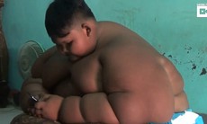 Bé trai phải cắt giảm dạ dày vì ăn nhiều và uống hàng lít nước coca mỗi ngày