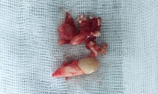 14 tuổi vẫn còn răng sữa, đi khám phát hiện u răng với hàng chục chiếc răng nhỏ
