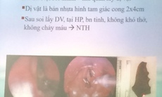 Khàn tiếng vì dị vật nằm trong đường thở 20 tháng