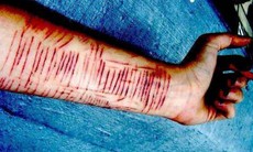 Hãi hùng nữ sinh dùng dao lam tự cứa tay 16 vết vì không được đi du học