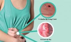 70% người Việt mắc vi khuẩn có thể gây ung thư dạ dày - Phòng bệnh cách nào?