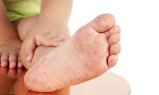 Bệnh tay chân miệng gia tăng, Bộ Y tế ra 6 khuyến cáo phòng bệnh