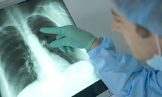 Thời tiết giao mùa: Cảnh giác viêm phổi cộng đồng