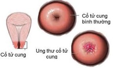 2.500 ca tử vong vì ung thư cổ tử cung mỗi năm tại Việt Nam