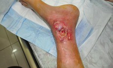 Bệnh nhân đái tháo đường bị cắt cụt chân vì tự ý ngâm nước nóng, lá cây lạ