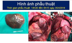 Hiếm gặp: Cắt u gan "khủng" 5kg ở bệnh nhân u cơ mỡ mạch gan