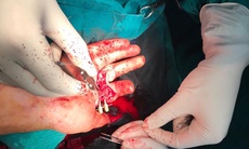 Vi phẫu nối 2 ngón tay đứt rời cho nam thanh niên bị tai nạn