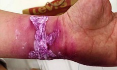 Tắm biển Quan Lạn, du khách bị sứa khổng lồ tấn công đau buốt