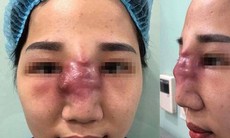 Nhiều vụ biến chứng sau tiêm filler làm đẹp: Đóa hoa đẹp bởi hương, không phải sắc