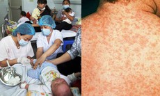 Hà Nội: Thêm 23 ca mắc sởi, không tiêm vắc xin dễ mắc bệnh