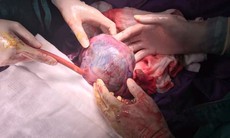 Bác sĩ bệnh viện tỉnh cứu sống sản phụ nhau bong non hiếm gặp