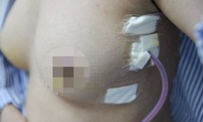Tự khám ngực lúc tắm, nữ thanh niên bất ngờ phát hiện u vú 2 bên và đã được chữa khỏi