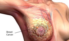 Loại bỏ u vú bằng kỹ thuật sinh thiết có hỗ trợ hút chân không