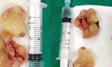 U mũi 6cm khiến bệnh nhân gần như không thở được bằng mũi