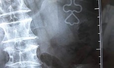 Cụ bà đau thắt lưng, hóa ra vòng tránh thai "đi lạc" tới ổ thận trái