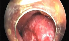 Nhiều trẻ bị polyp đại trực tràng đi ngoài ra máu, cha mẹ lầm tưởng con bị táo bón