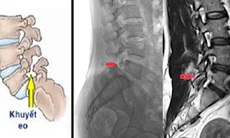 Đau lưng khi tập thể dục, không ngờ bị hở eo đốt sống