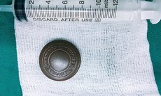 Ngậm đá nano chữa viêm họng lúc ngủ, cụ bà "nuốt chửng" phải cấp cứu