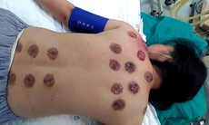 Một phụ nữ nhiễm trùng da, lở loét lưng sau khi giác hơi