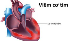 Bộ Y tế: Chưa ghi nhận chủng vi rút "mới lạ" gây viêm cơ tim