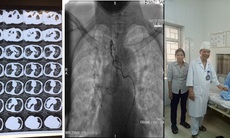 Cứu sống cụ ông ho ra máu "sét đánh", căn bệnh có tỉ lệ tử vong gần như 100%