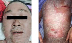 Người đàn ông "đóng vảy" toàn thân sau tiêm corticoid, dùng thuốc nam chữa vảy nến