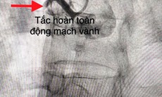 Cảnh báo cơn đau ngực dữ dội có thể gây tử vong nhanh chóng